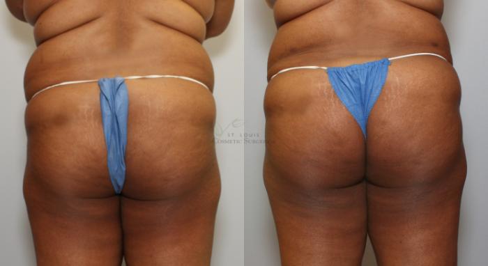 Before & After Brazilian Butt Lift Case 71 View #1 View in St. Louis, MO