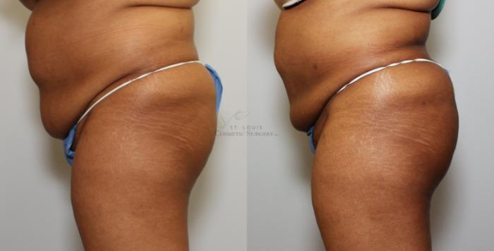 Before & After Brazilian Butt Lift Case 71 View #2 View in St. Louis, MO