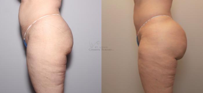 Before & After Brazilian Butt Lift Case 97 View #1 View in St. Louis, MO
