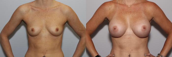 Before & After Breast Augmentation Case 105 View #1 View in St. Louis, MO