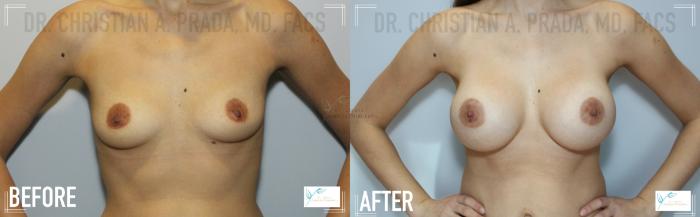 Before & After Breast Augmentation Case 110 Front View in St. Louis, MO