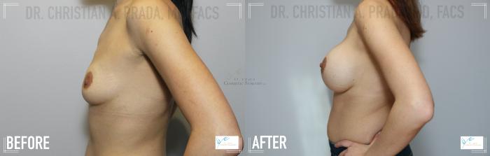 Before & After Breast Augmentation Case 110 Left Side View in St. Louis, MO