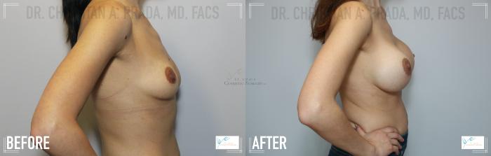 Before & After Breast Augmentation Case 110 Right Side View in St. Louis, MO