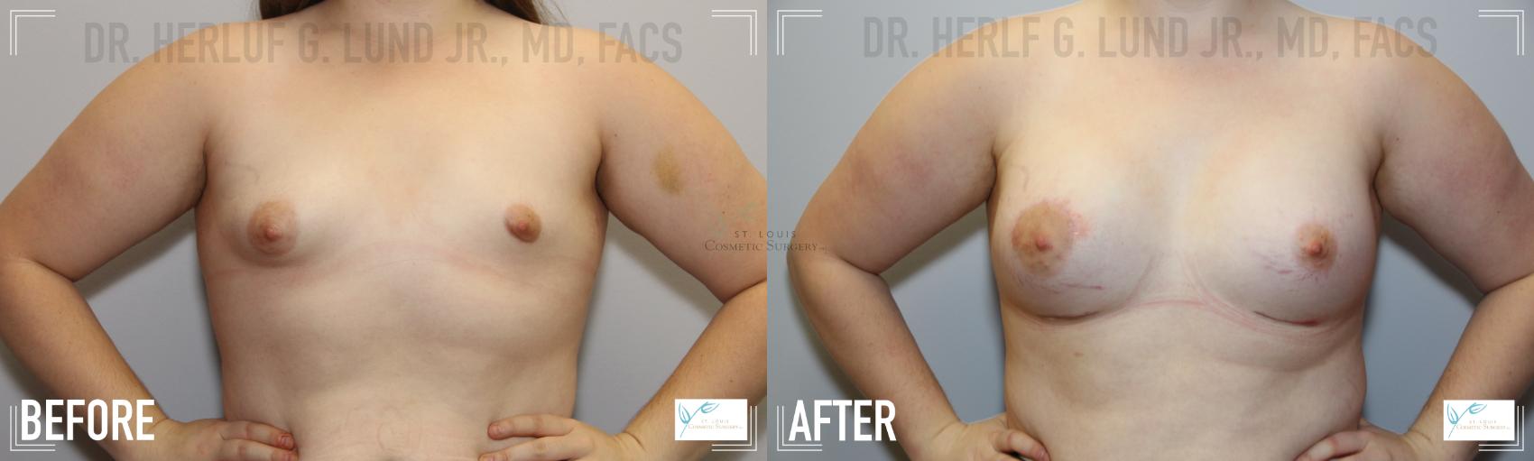 Before & After Breast Augmentation Case 113 Front View in St. Louis, MO