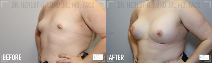 Before & After Breast Augmentation Case 113 Left Oblique View in St. Louis, MO