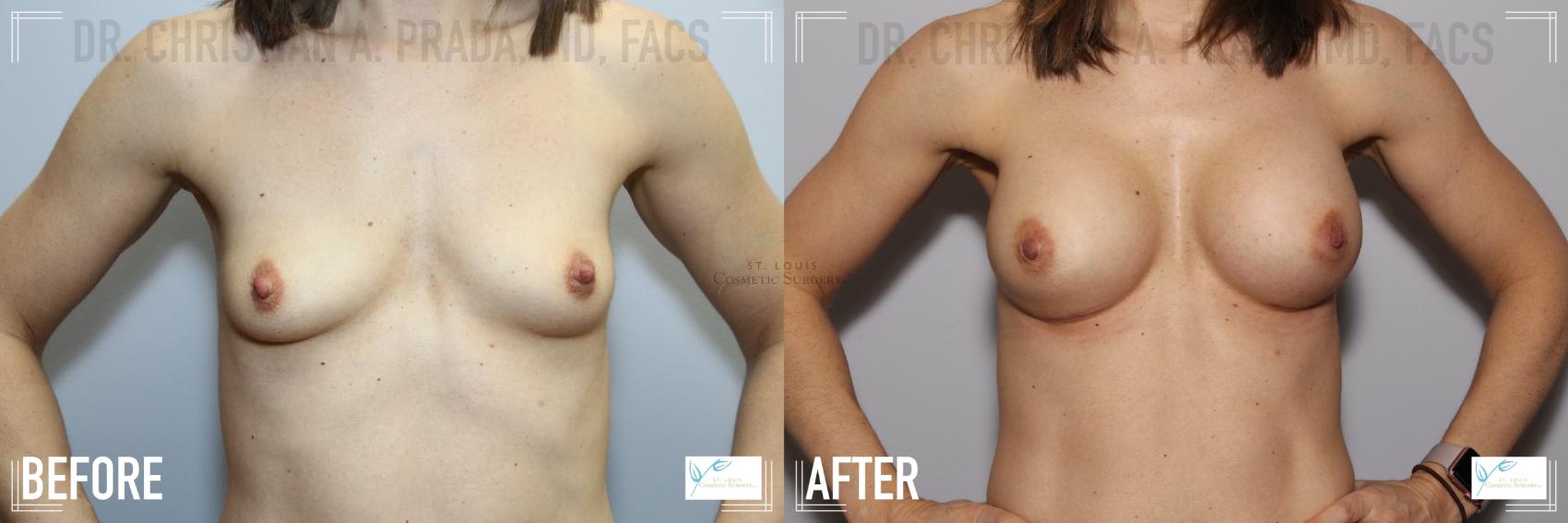 Before & After Breast Augmentation Case 116 Front View in St. Louis, MO