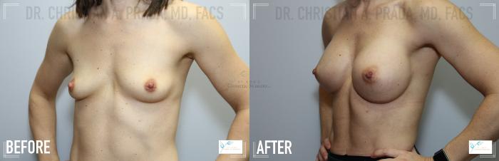 Before & After Breast Augmentation Case 116 Left Oblique View in St. Louis, MO
