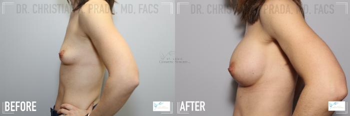 Before & After Breast Augmentation Case 116 Left Side View in St. Louis, MO