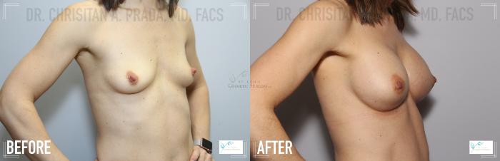 Before & After Breast Augmentation Case 116 Right Oblique View in St. Louis, MO