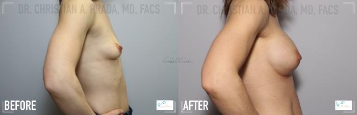 Before & After Breast Augmentation Case 116 Right Side View in St. Louis, MO