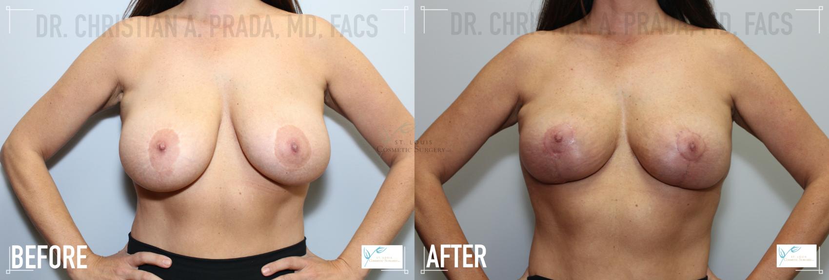 Before & After Breast Augmentation Case 123 Front View in St. Louis, MO