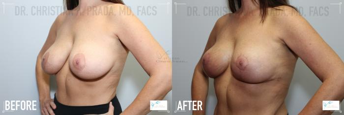 Before & After Breast Augmentation Case 123 Left Oblique View in St. Louis, MO