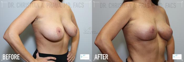 Before & After Breast Augmentation Case 123 Right Oblique View in St. Louis, MO