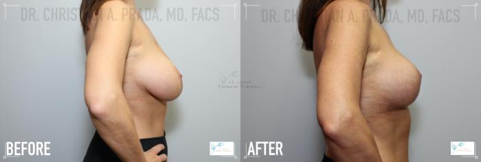 Before & After Breast Augmentation Case 123 Right Side View in St. Louis, MO