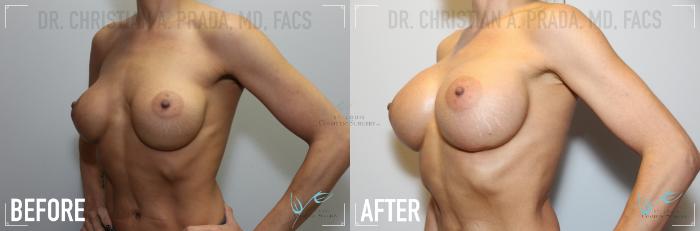 Before & After Breast Augmentation Case 124 Left Oblique View in St. Louis, MO