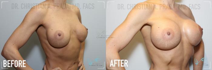 Before & After Breast Augmentation Case 124 Right Oblique View in St. Louis, MO
