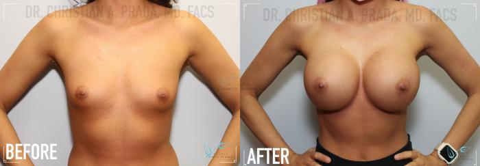Before & After Breast Augmentation Case 125 Front View in St. Louis, MO