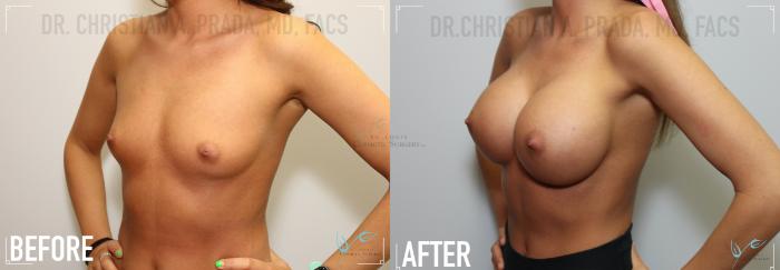Before & After Breast Augmentation Case 125 Left Oblique View in St. Louis, MO