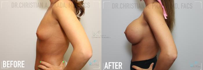 Before & After Breast Augmentation Case 125 Left Side View in St. Louis, MO
