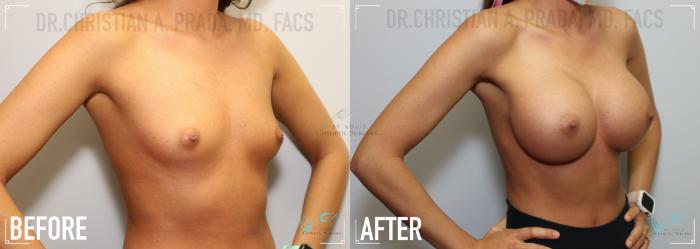 Before & After Breast Augmentation Case 125 Right Oblique View in St. Louis, MO