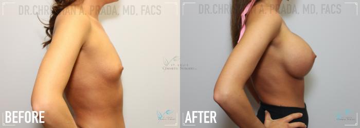 Before & After Breast Augmentation Case 125 Right Side View in St. Louis, MO