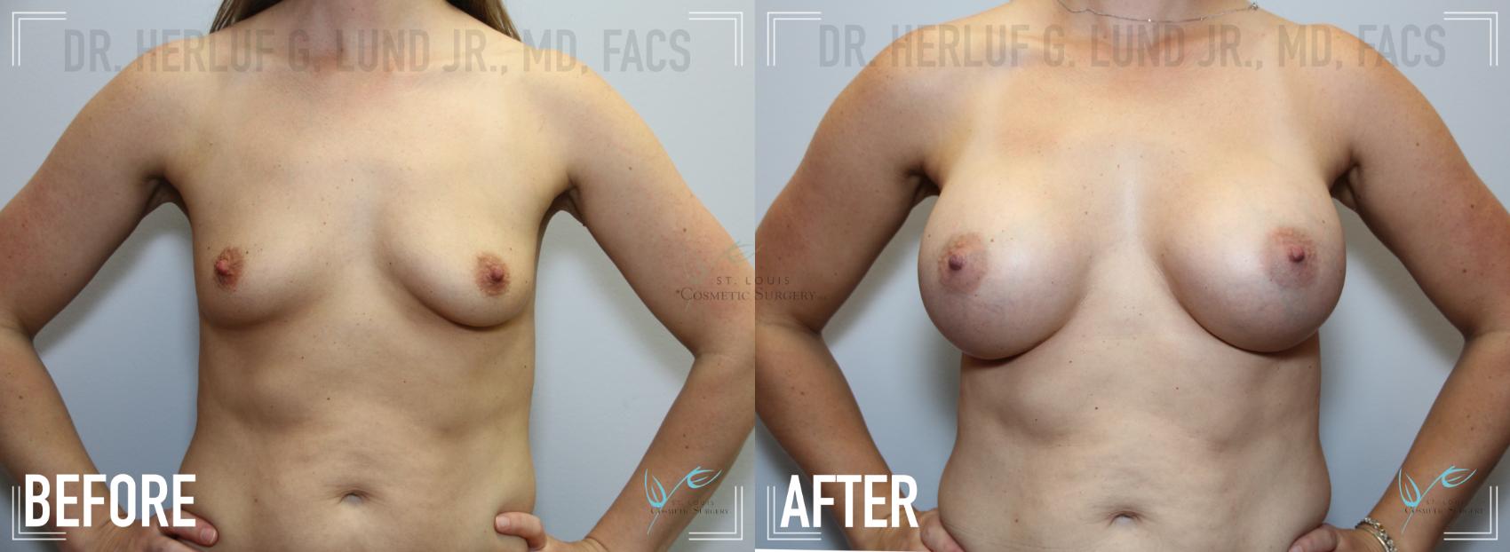 Before & After Breast Augmentation Case 127 Front View in St. Louis, MO