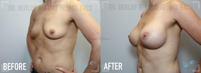Before & After Breast Augmentation Case 127 Left Oblique View in St. Louis, MO