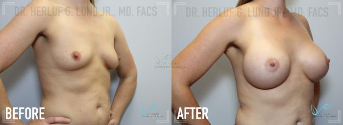 Before & After Breast Augmentation Case 127 Right Oblique View in St. Louis, MO