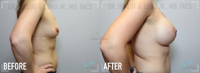 Before & After Breast Augmentation Case 127 Right Side View in St. Louis, MO
