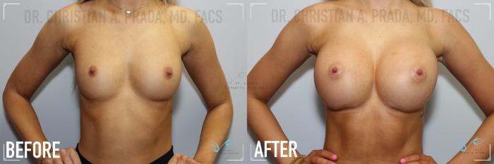 Before & After Breast Augmentation Case 130 Front View in St. Louis, MO