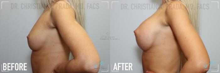 Before & After Breast Augmentation Case 130 Left Side View in St. Louis, MO