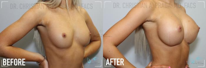 Before & After Breast Augmentation Case 130 Right Oblique View in St. Louis, MO