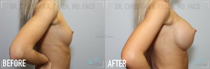 Before & After Breast Augmentation Case 130 Right Side View in St. Louis, MO