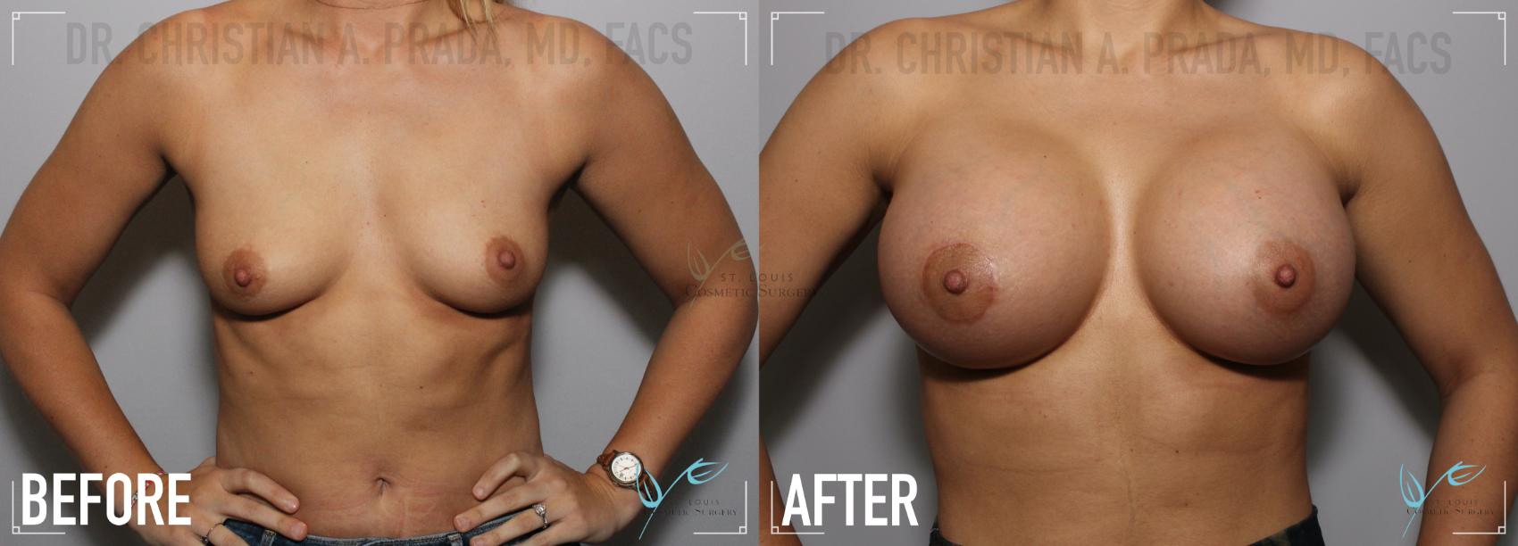 Before & After Breast Augmentation Case 131 Front View in St. Louis, MO