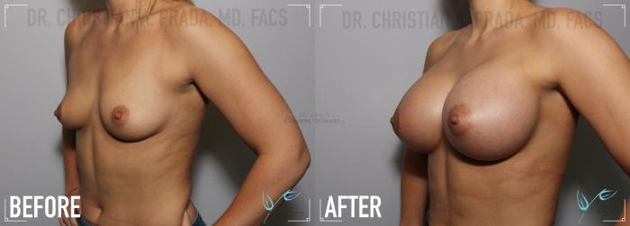 Before & After Breast Augmentation Case 131 Left Oblique View in St. Louis, MO