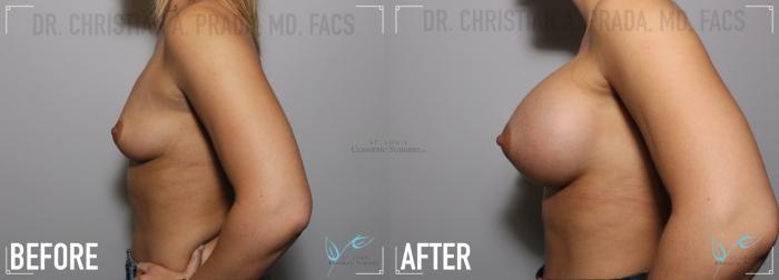 Before & After Breast Augmentation Case 131 Left Side View in St. Louis, MO