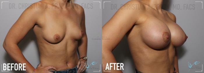 Before & After Breast Augmentation Case 131 Right Oblique View in St. Louis, MO