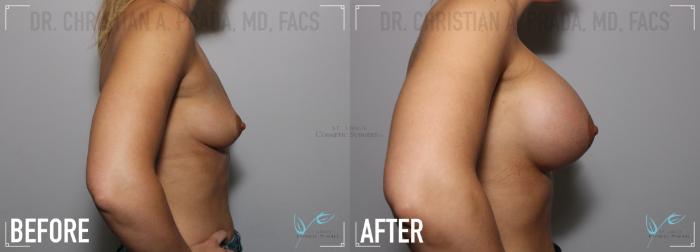 Before & After Breast Augmentation Case 131 Right Side View in St. Louis, MO