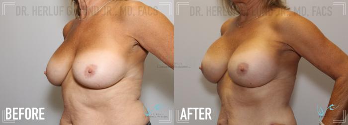 Before & After Breast Augmentation Case 132 Left Oblique View in St. Louis, MO