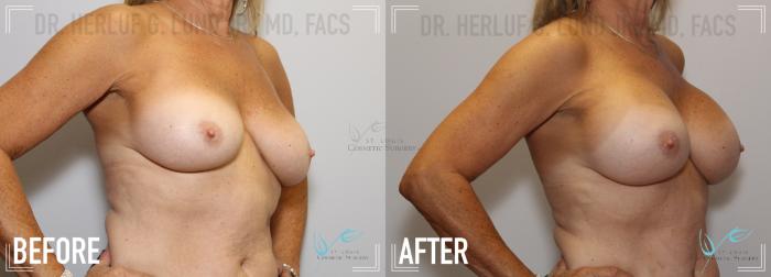 Before & After Breast Augmentation Case 132 Right Oblique View in St. Louis, MO