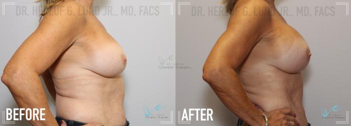 Before & After Breast Augmentation Case 132 Right Side View in St. Louis, MO