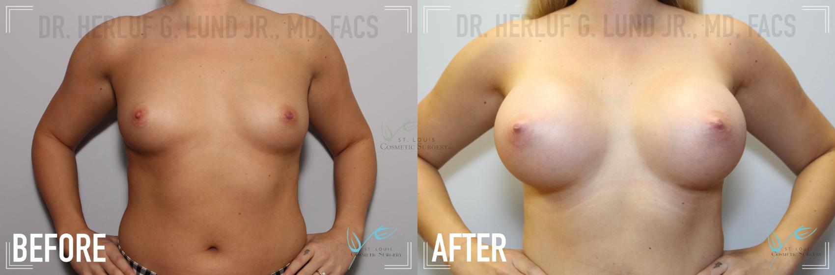 Before & After Breast Augmentation Case 136 Front View in St. Louis, MO
