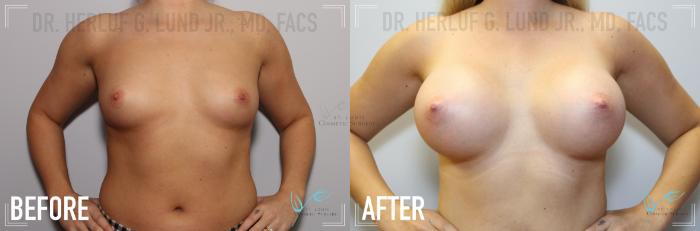 Before & After Breast Augmentation Case 136 Front View in St. Louis, MO