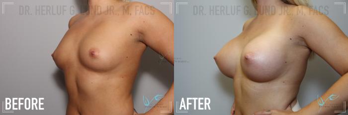 Before & After Breast Augmentation Case 136 Left Oblique View in St. Louis, MO