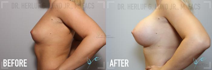 Before & After Breast Augmentation Case 136 Left Side View in St. Louis, MO