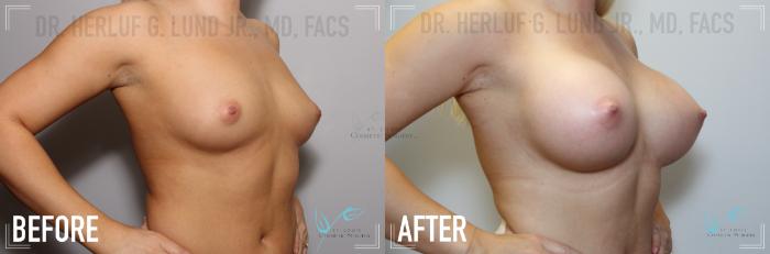 Before & After Breast Augmentation Case 136 Right Oblique View in St. Louis, MO