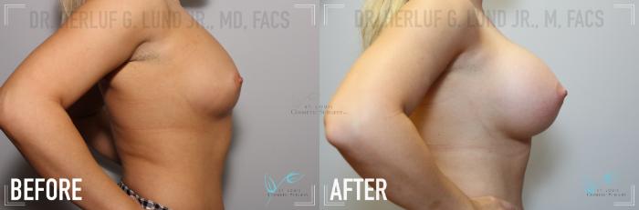 Before & After Breast Augmentation Case 136 Right Side View in St. Louis, MO