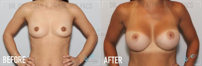Before & After Breast Augmentation Case 137 Front View in St. Louis, MO