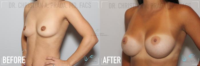 Before & After Breast Augmentation Case 137 Left Oblique View in St. Louis, MO