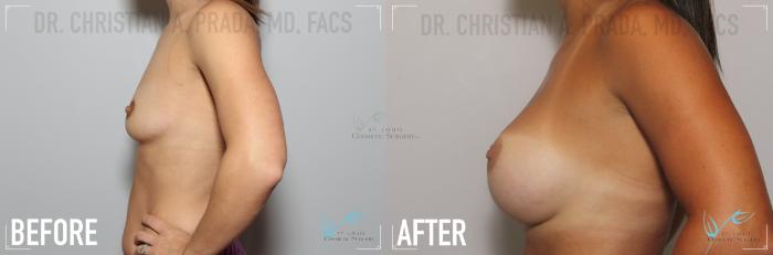 Before & After Breast Augmentation Case 137 Left Side View in St. Louis, MO